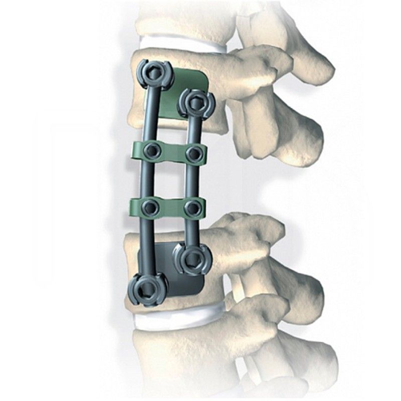 Пластина Stryker XIA anterior